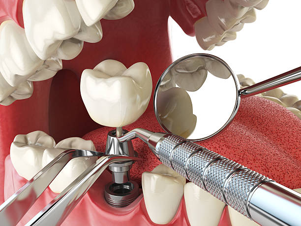Best Emergency Tooth Extraction in Mount Carmel, OH